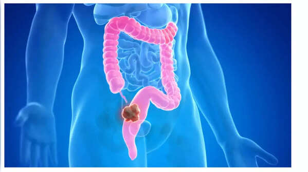 The impact of weight loss as an early indicator of colon cancer