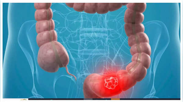 Recognizing abdominal pain and discomfort related to colon cancer