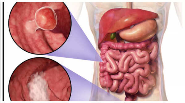 Detecting blood in stool, a key symptom of colon cancer